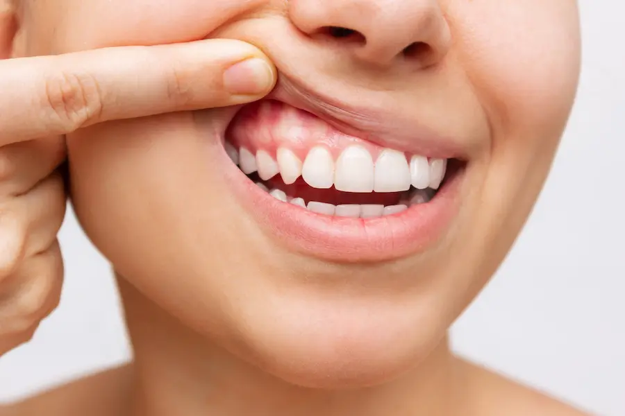Sustaining Gum Health After Treatment: Periodontal Maintenance In Jackson Heights, NY